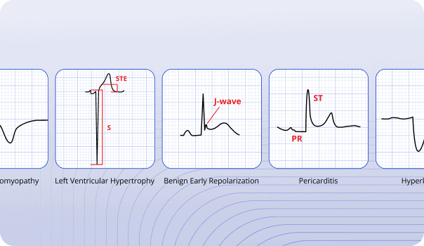 ECG waveforms showing common STEMI mimics such as LVH, BER, and pericarditis with annotated features like ST elevation and J-waves.