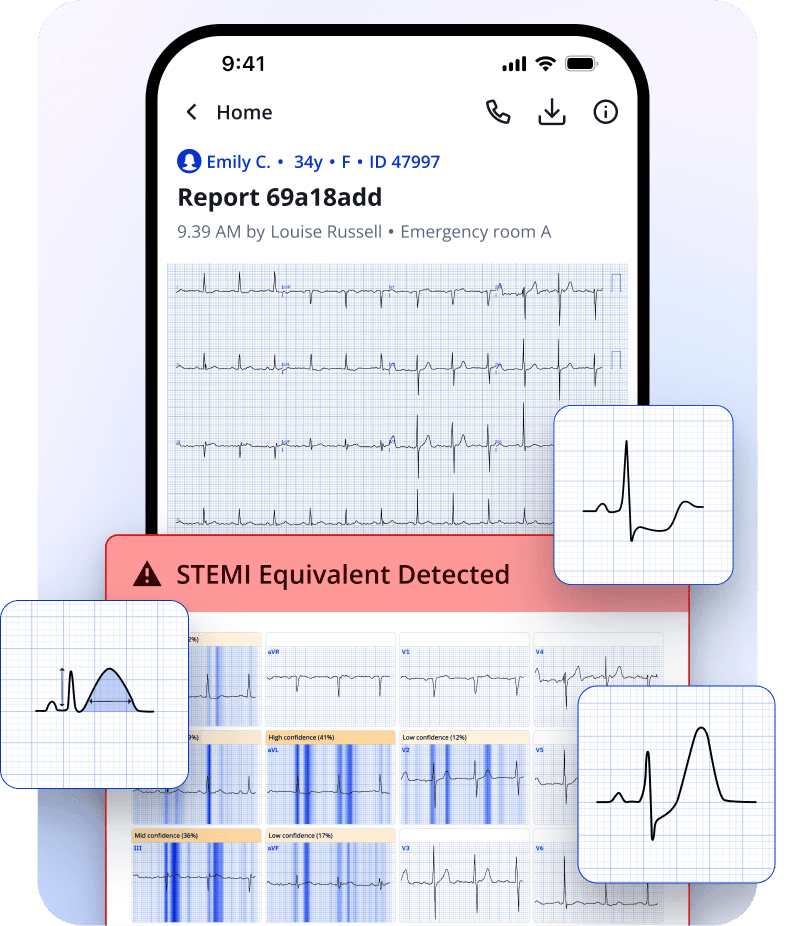 PMcardio Queen of Hearts STEMI AI ECG model detecting STEMI equivalent on a 12-lead ECG with high accuracy and reduced false positives.