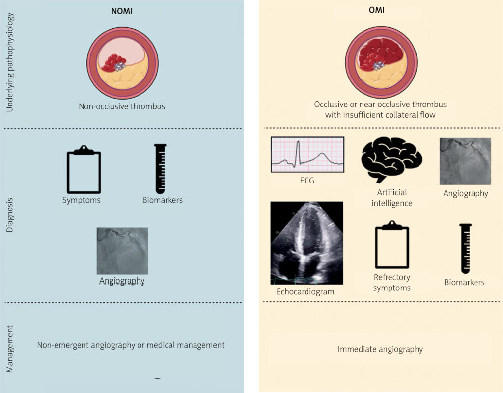 Occlusion Myocardial Infarction: A Revolution in Acutecoronary Syndrome