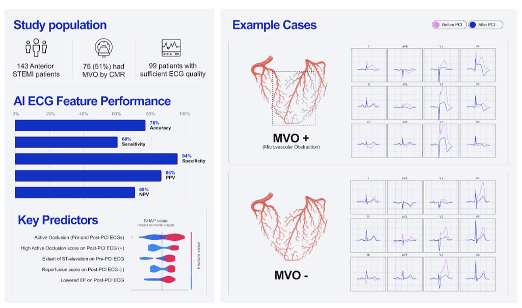Association Between Artificial Intelligence Detected Features on the ECG and Presence of Microvascular Obstruction