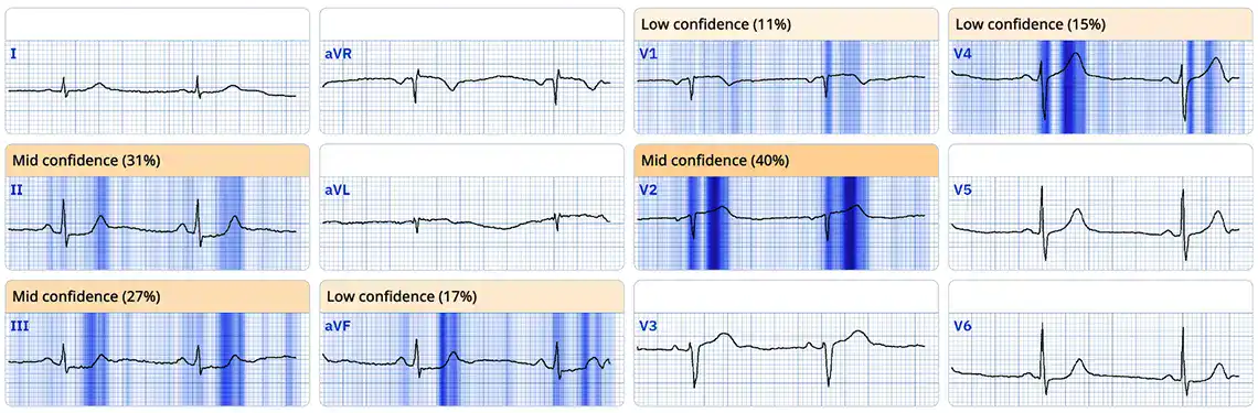 LAD Occlusion Identified and Activated by Paramedic