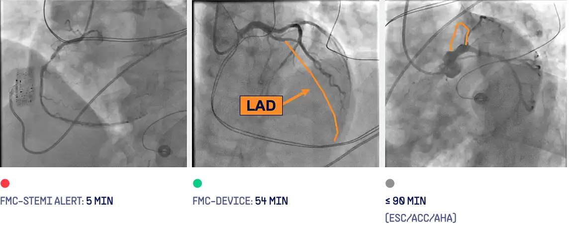 LAD Occlusion Identified and Activated by Paramedic