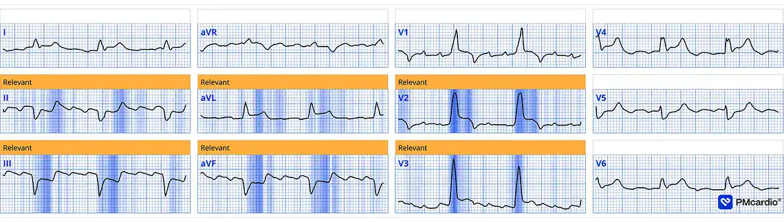 Bifascicular Block Identified as STEMI-Equivalent by Queen of Hearts