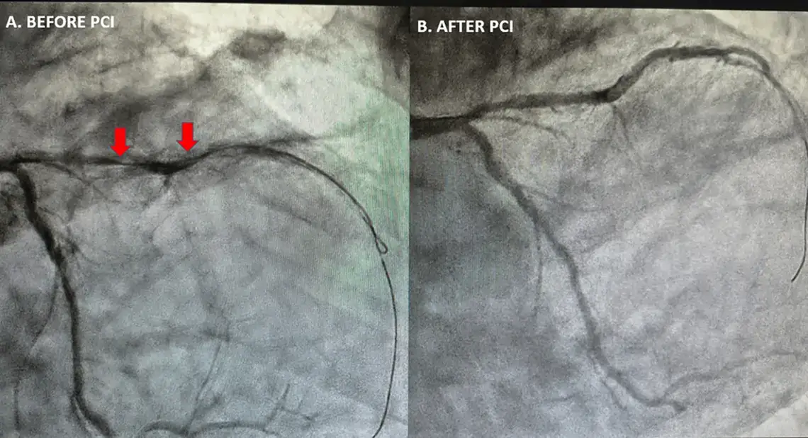 Bifascicular Block Identified as STEMI-Equivalent by Queen of Hearts