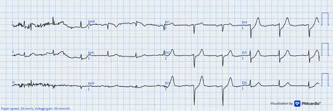 De Winter Pattern Identified Before STEMI Criteria