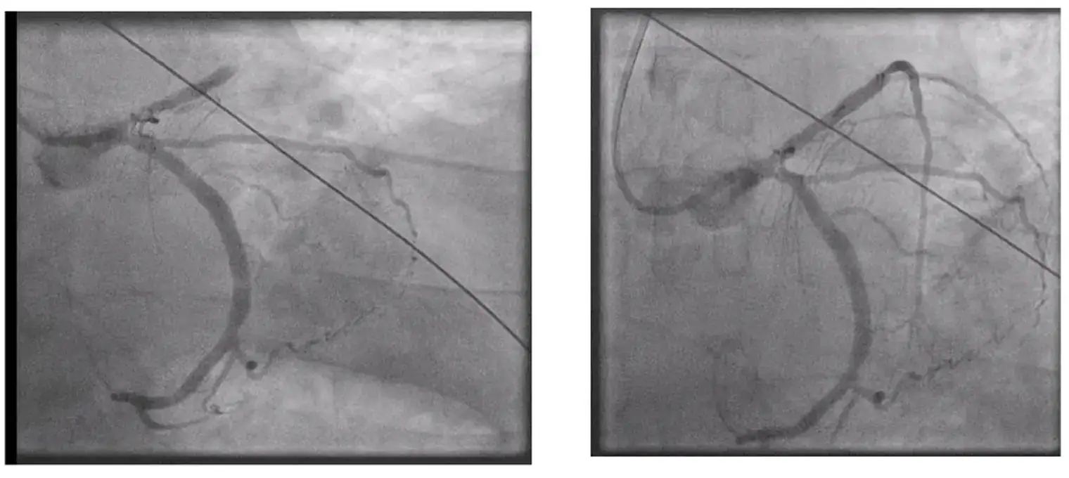 De Winter Pattern Identified Before STEMI Criteria