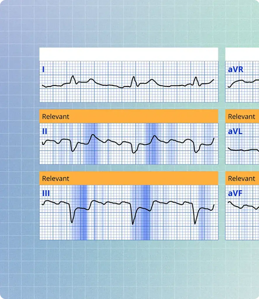 PMcardio STEMI AI ECG Model
