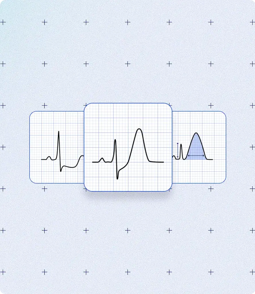 PMcardio STEMI AI ECG Model
