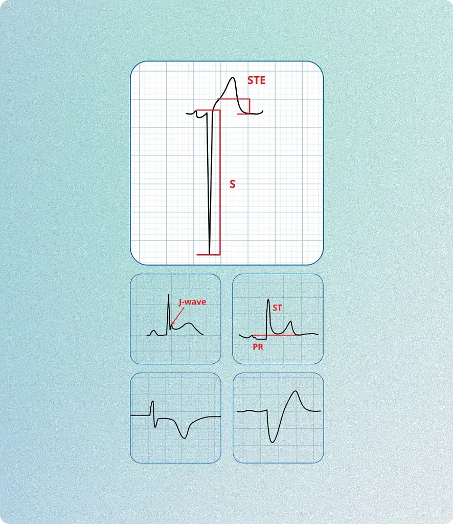 PMcardio STEMI AI ECG Model