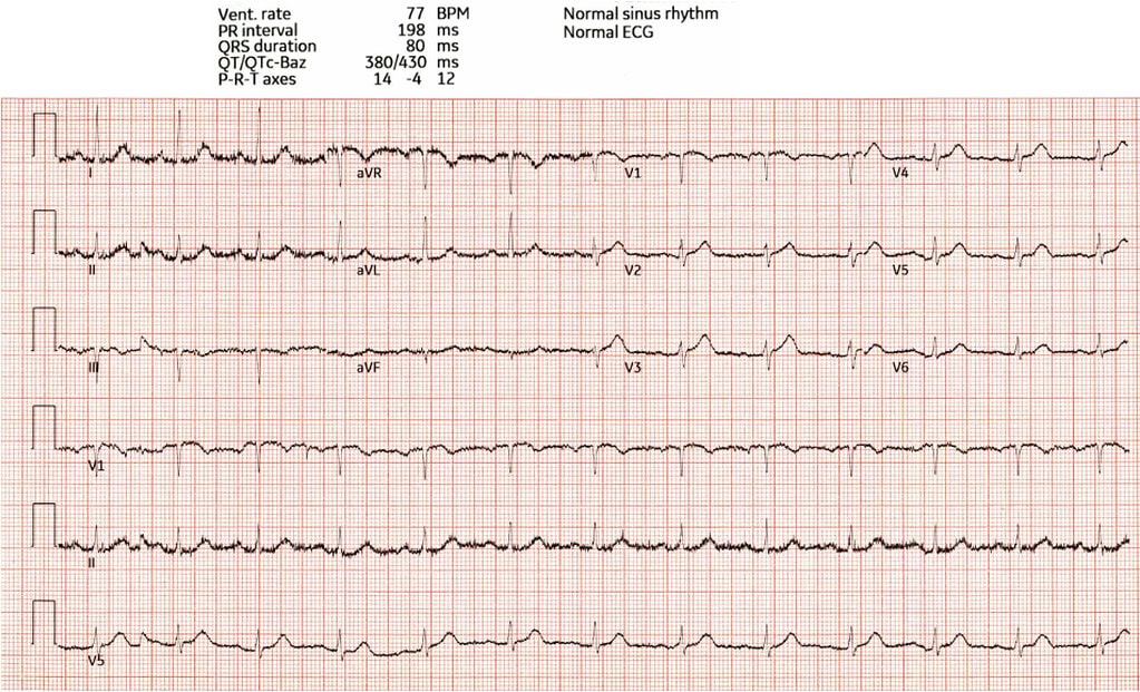 Chest Pain With Subtle But Lifesaving ECG Findings