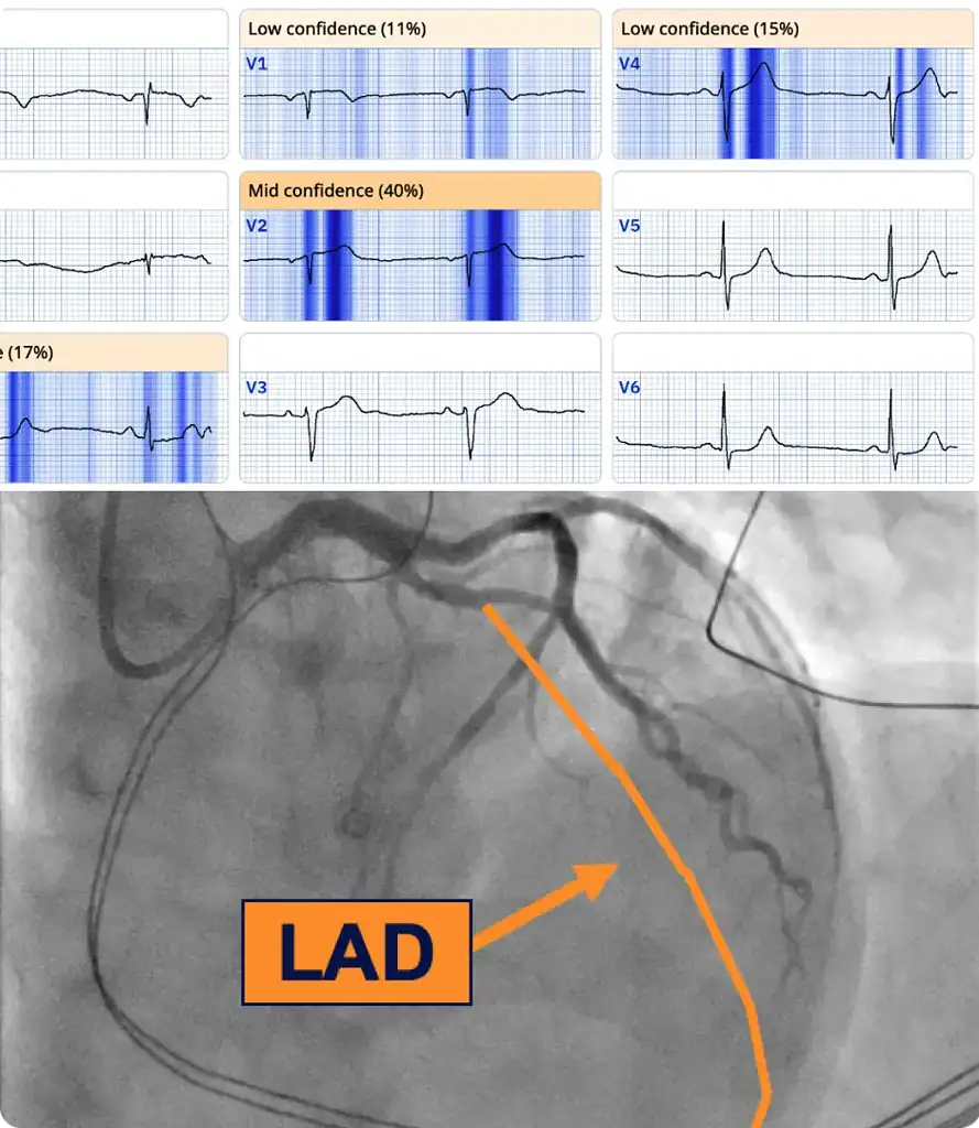 PMcardio STEMI AI ECG Model