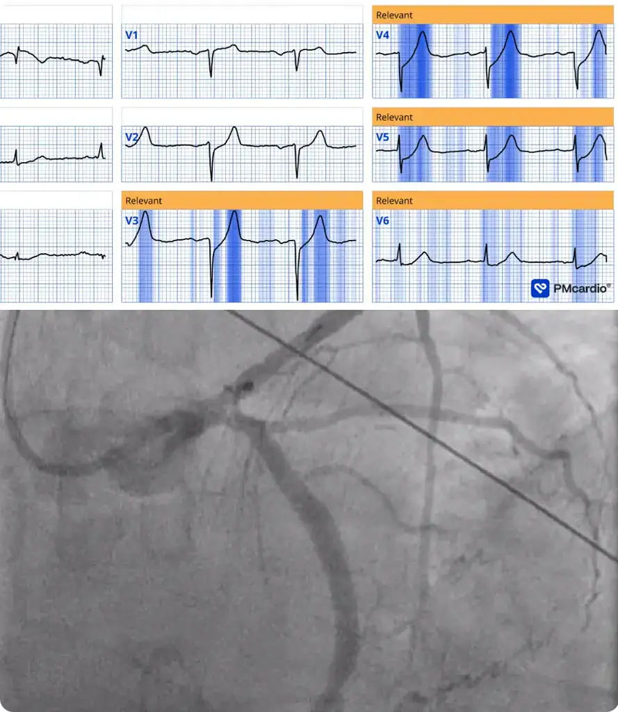 PMcardio STEMI AI ECG Model