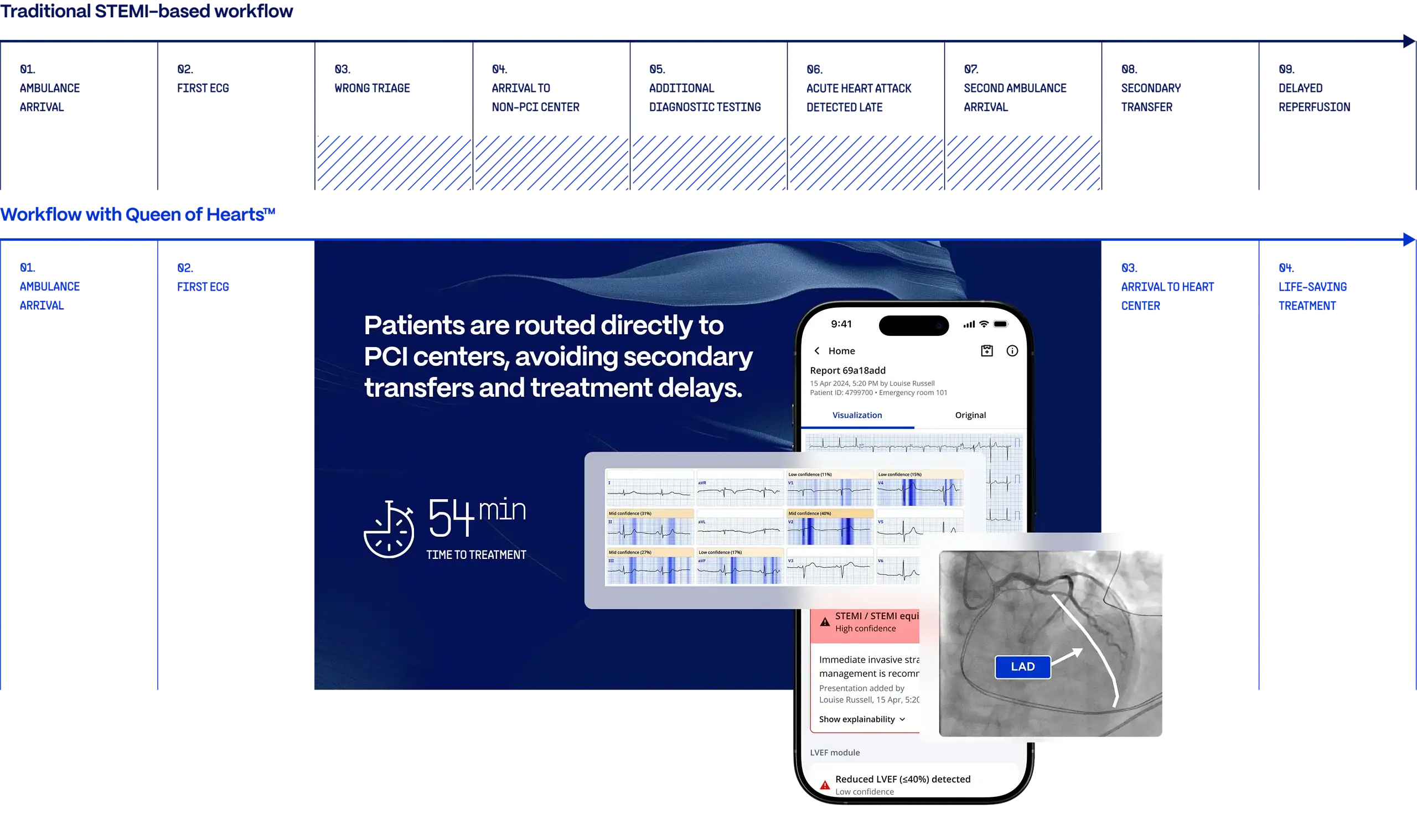 PMcardio STEMI AI ECG Model